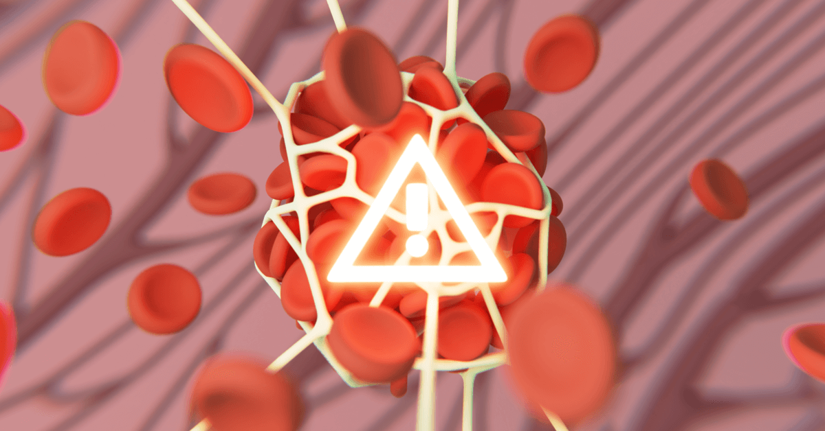 What Is PostThrombotic Syndrome?